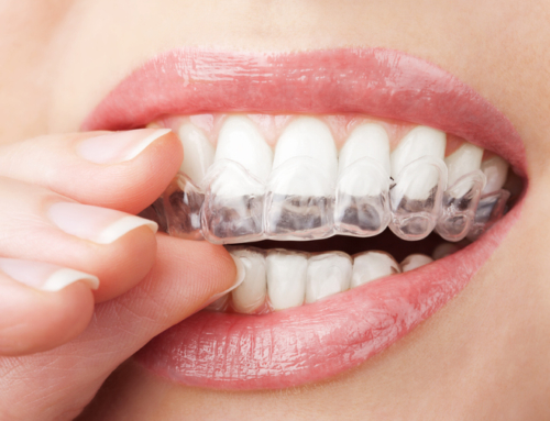 ¿INVISALIGN DAÑA LOS DIENTES?