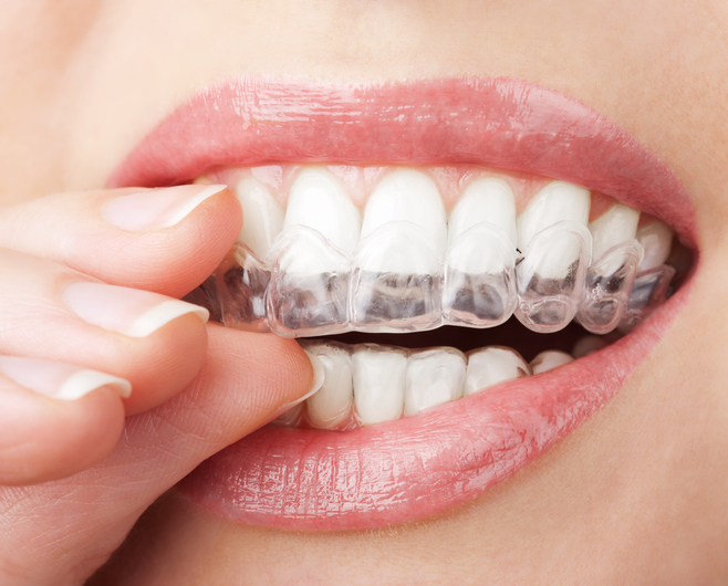 teeth with whitening tray